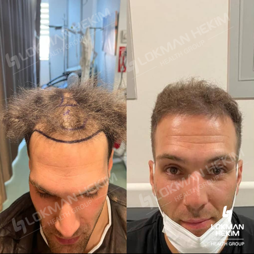 Photos Avant / Après - Chirurgie Fox Eyes - Exp. Ömer Faruk Öğe